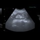 Angiomyolipoma of kidney, renal angiomyolipoma: US - Ultrasound